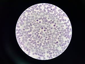 Malaria pigment blood parasite infected red blood cells