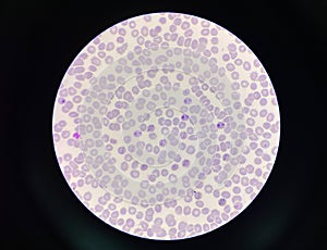 Malaria pigment blood parasite infected red blood cells