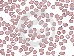 Malaria.Ring forms of plasmodium falciparum in peripheral blood. photo