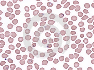Malaria.Ring forms of plasmodium falciparum in peripheral blood. photo