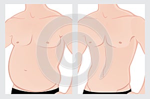 Male abdomen before and after treatment photo