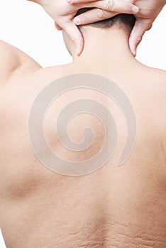 Male back with stretch marks