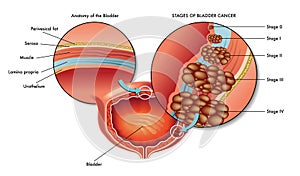 Male bladder Cancer photo