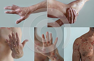 Collage of male body parts affected by blistering rash because of monkeypox or other viral infection photo