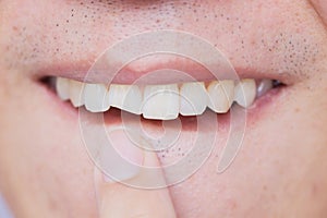 Male broken teeth damaged cracked front tooth