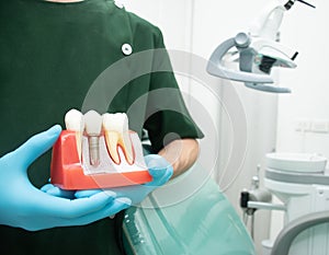 Male dentist carrying a sample of dental implants