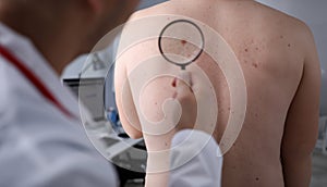 Male doctor look at magnifying glass on patient skin