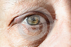 Male eye with thickening on eyelid from chalazion