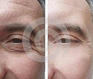 Samec oko vrásky před a po dermatologie ošetření 