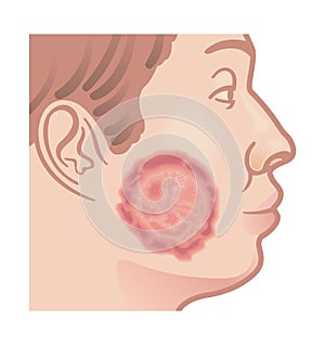 Male face suffering from ringworm