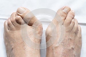 Male feet together with big bunions and hammer toes