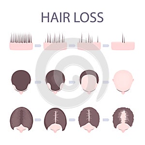 Male and female hair loss