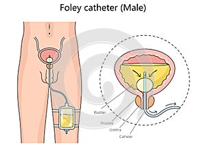 Male foley catheter diagram medical science