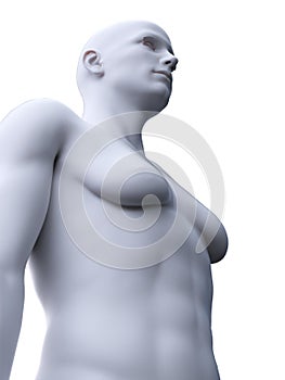 A male with gynecomastia