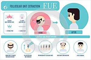 FUE treatment infographic for men photo