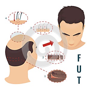 FUT transplantation hair loss medical treatment poster