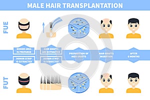 Male hair tranplantation with FUE, FUT methods