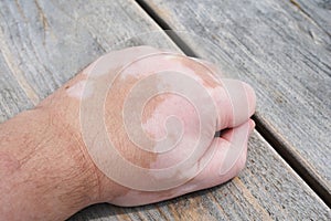 Male hand with vitiligo skin condition