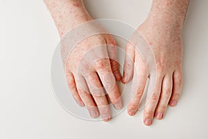 Male hands on white table with red spots on skin. Allergic reaction, skin problems, dermatology. Wrong diet, side effect from