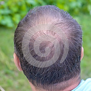 Male head with thinning hair or alopecia