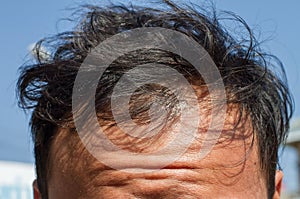 Male head with thinning hair or alopecia, balding