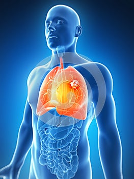 Male lung - cancer