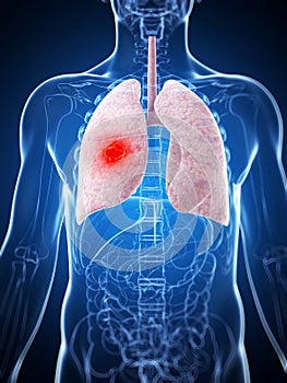 Male lung - cancer