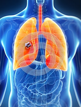 Male lung - cancer