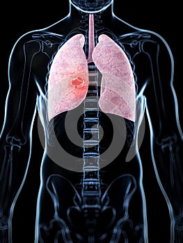 Male lung - cancer