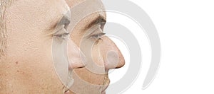 Male nose hump before and after treatment  procedure difference