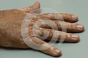 Male patient with vitiligo disease.
