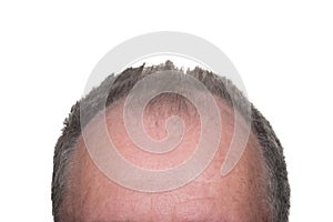 Male Pattern Baldness photo