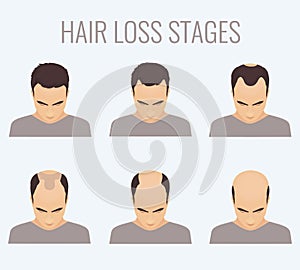 Male pattern baldness stages