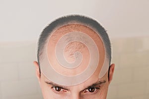 Male pattern hair loss problem concept. Baldness, alopecia in males