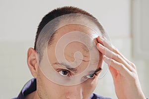 Male pattern hair loss problem concept. Baldness, alopecia in males