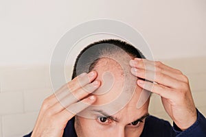 Male pattern hair loss problem concept. Baldness, alopecia in males