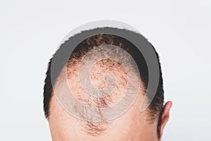 Male pattern hair loss problem concept. Baldness, alopecia in males