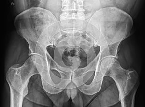 Male pelvis X-Ray