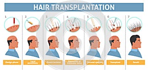 Male person hair transplantation step info poster