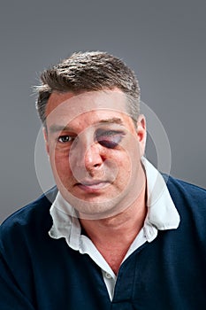 Male portrait with bruised eye