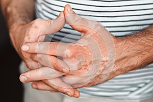 Male posing his hands with Vitiligo Disease close-up