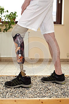 Male prosthesis wearer learning to transfer weight photo