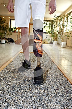 Male prosthesis wearer learning to walk photo