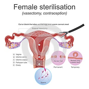 Female sterilisation vasectomy. The male reproductive system these work together to produce sperm. Cut or block the tubes so that