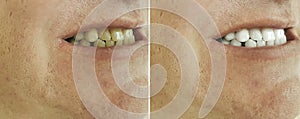 Male teeth before and after bleaching, treatment
