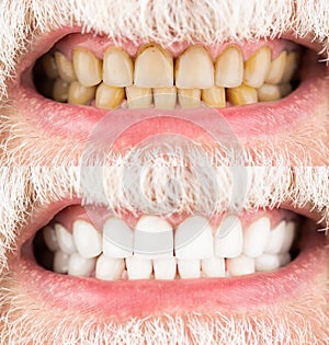 Male teeth before and after whitening, oral care dentistry, stomatology. Smiling man before and after teeth whitening