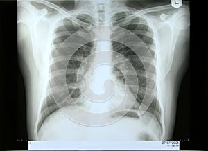 Male torax xray photo