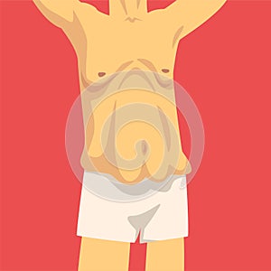 Male Torso with Sagging Belly, Human Body After Weight Loss, Front View, Obesity and Unhealthy Eating Problems Vector