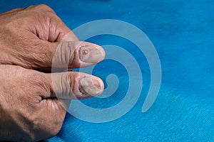 Males thumbs with fungal nail infection.