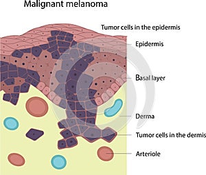 Malignant melanoma. Skin disease. Skin cancer